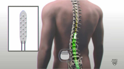 Paralyzed man moves legs using EMS device that stimulates spinal cord